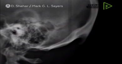 Detactan que uso de 'smartphones' está provocando crecimiento de protuberancia en el cráneo humano